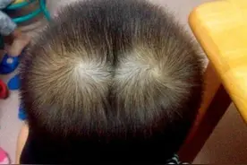 为啥有的孩子头上有2个“旋”?关于头旋的奥秘，家长要了解图片