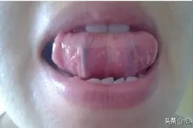 舌下青筋是怎么一回事？怎样的才是正常的？一文详细解说图片