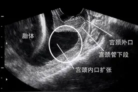 宫颈短了会早产吗？图片