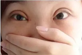 为什么80%以上的人做出的双眼皮不自然 形成了肉条眼？图片