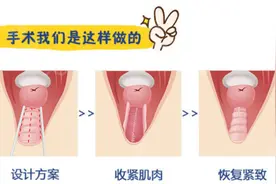 做私密整形手术前，您需要了解这些图片
