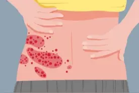 “缠腰龙”致疼痛难忍！注射带状疱疹疫苗可防可控图片