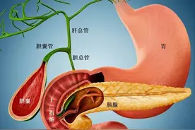 肝胆疾病中最棘手的病症之一——胰管结石，又一真实案例图片