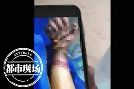 帮帮他吧！江西8岁男童意外触电双手截肢，高昂医药费让全家崩溃图片