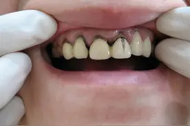 烤瓷牙虽好，也不要乱镶！使用烤瓷牙这几个禁忌必须了解清楚图片
