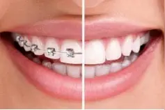 保持器是什么，为什么整完牙还要戴保持器，可以不戴吗？图片