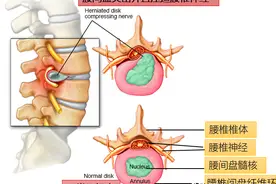 腰椎间盘突出压迫神经了，屁股和腿疼，有什么好的治疗方法？图片