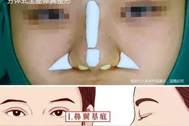 膨体填充鼻基底后不能笑，一笑还有小胡子？听听整形医生怎么说？图片