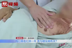 七旬大爷胸口肿个大包，五年了，才知道与心脏起搏器有关图片