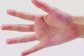 手上出现3个变化，说明你的肝在“求救”！早发现才能早治疗图片