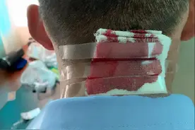 可敬的人！云南戍边战疫民警被蚂蟥叮咬后大出血，被咬了怎么办？图片