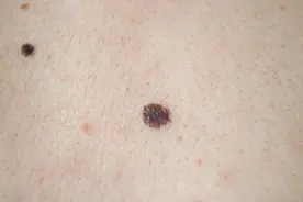 痣变大凸起就一定是要癌变了吗？图片