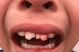 孩子牙摔断了，得尽快处理，可别干着急图片