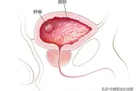 哪些不良的生活习惯会导致膀胱癌？早注意早预防图片