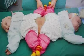 中国首例“坐骨连体”双胞胎女孩，成功分离已11年，现状好不好图片