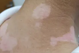 白癜风是个什么鬼？能治好吗？看看医生怎么说图片