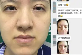 双眼皮术后有问题，医生老是说我未恢复好，是不是在应付自己？图片