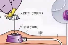 输液港，究竟是个啥？图片
