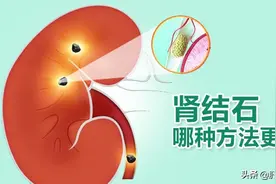 肾结石最快的排石方法，看完自己就会选图片