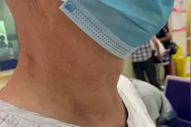 70岁老者甲状腺结节14年未治！拖到4cm大小，压迫气管，呼吸都疼图片