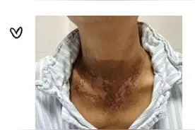 鼻咽癌：放疗期中的健康小知识图片