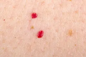 身上出现很多小红点,是不是身体出了问题?图片