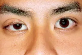 身体出问题，眼睛发信号！医生提醒：这几种眼部症状早查，别拖图片