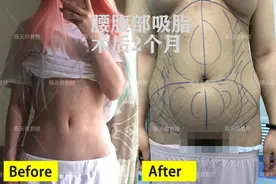 吸脂加液体只吸3500c正常吗？图片