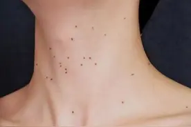 打了HPV疫苗也会感染HPV吗？感染了HPV会得宫颈癌吗？图片