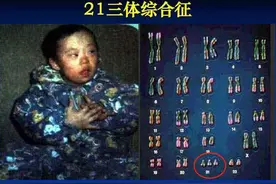 世界唐氏综合征日：三类孕妇易怀“唐氏儿”，两项产检筛查很关键图片