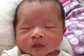 月嫂：湿疹瘙痒折磨宝宝睡不好？3个实用妙招，宝宝少受罪图片