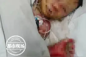 “像小原子弹爆炸”！2岁女童玩耍时，被路边煤炉严重烧伤图片