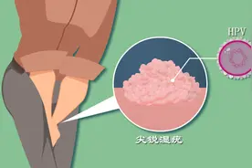 HPV感染风险有多高？尖锐湿疣到底咋感染的？图片