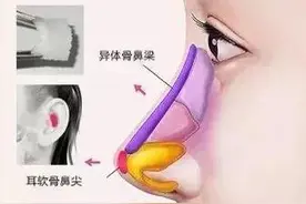 鼻综合手术术前准备工作图片