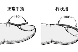 抽烟抽了几十年？劝告“老烟枪”：出现4个不适，要怀疑肺癌了图片