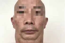 包块野蛮生长七年多！51岁成都男子患上罕见的马德龙病，全球目前仅发现400来例图片