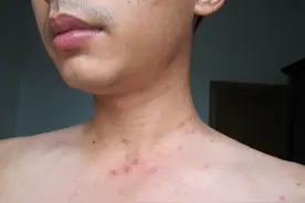 不要错把艾滋病当皮肤病，身体若有几个变化，可能是艾滋病的信号图片