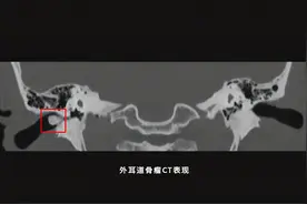 【科普系列】耳朵里的硬骨头，外耳道骨瘤图片