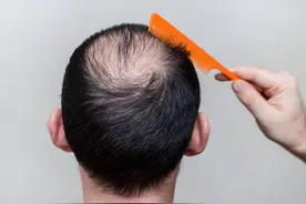 脱发部位的细小绒毛怎么长成头发？图片