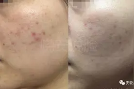 “外油内干”+轻微敏感+痘痘肌的换季改造图片