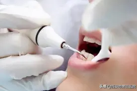 【口腔健康】洗牙那些事儿图片