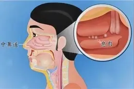“鼻息肉”有癌变的风险！必须切除，而你却不知道图片