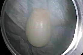 六旬老人误信谣言 吃整颗大蒜卡食管图片
