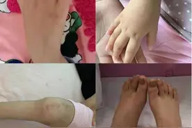 世界关节炎日——做您孩子的“关节卫士”图片