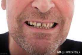 我什么都没做，为什么牙齿会发黑？图片