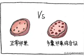 #健康中国行动2030# 什么是多囊卵巢综合征？图片