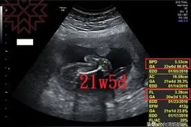 一张死亡证明（怀孕26w3d），FGFR3基因突变/侏儒症图片