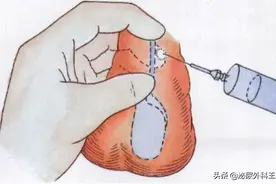 男性做了结扎，和正常人有区别吗？会不会影响性功能？图片