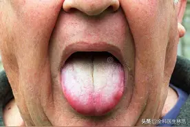 舌头上的3种异常，提示身体出了问题，教你一招，轻松调理脾胃图片