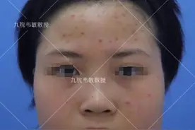 成功的下颌角手术，改善的不仅仅是容貌图片